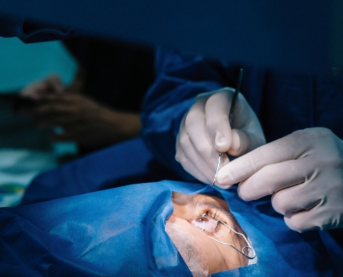 cataract surgery