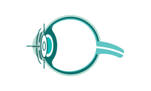 Corneal Conditions eye care faqs