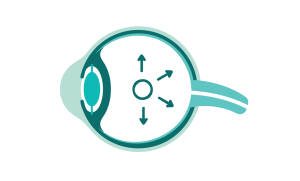 Glaucoma eye care faqs