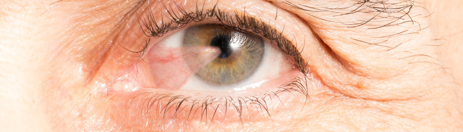 Pterygiums eye care faqs