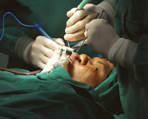 Retinal detachment