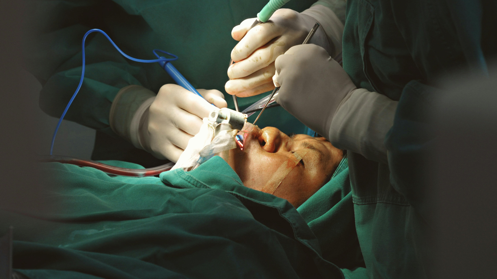 Retinal detachment